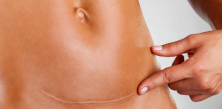 my top c-section recovery tips